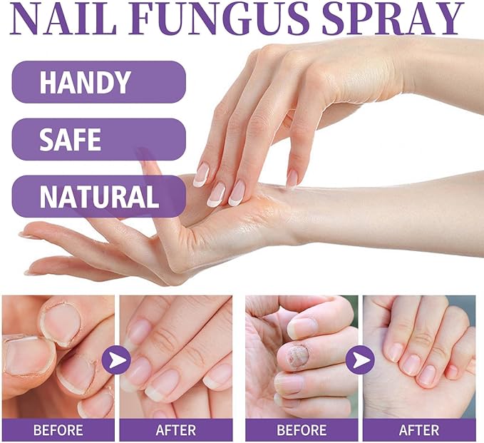 Nail Fungus Spray - Elvoque