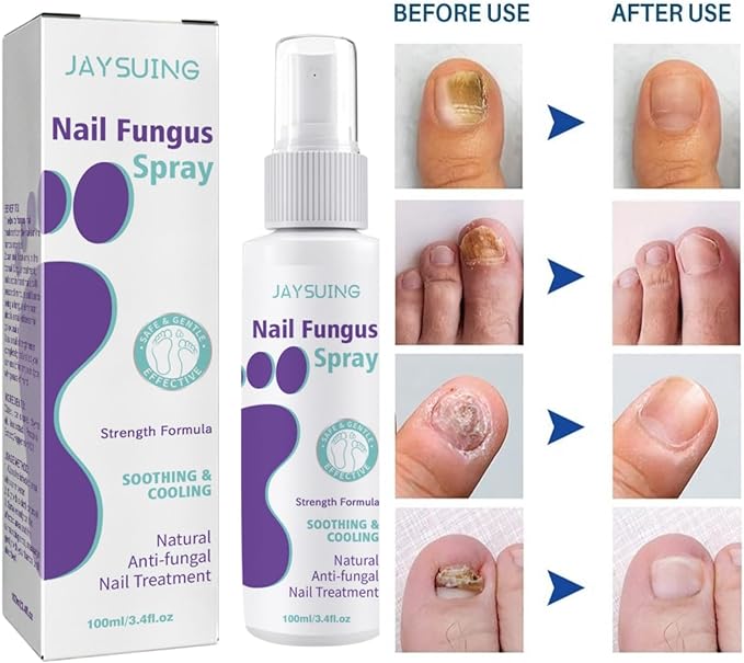Nail Fungus Spray - Elvoque