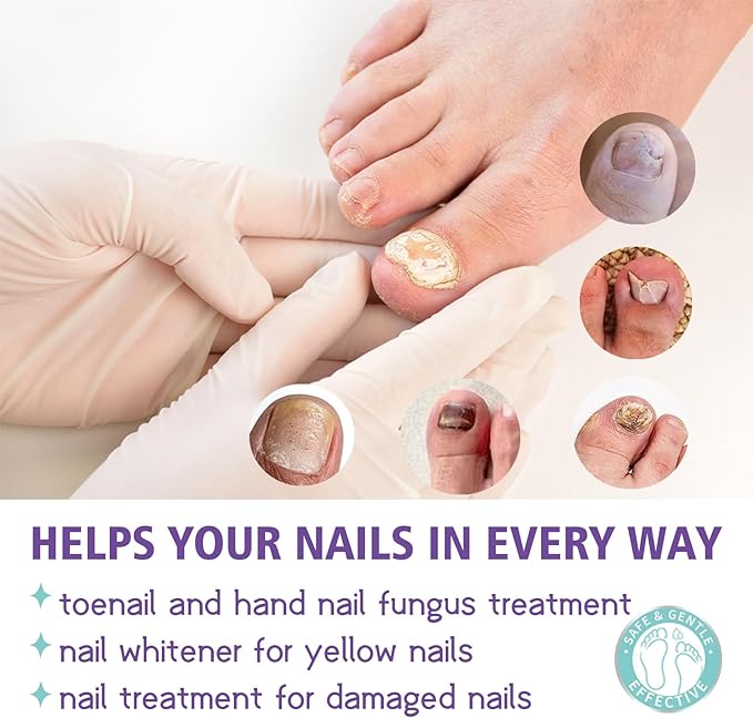 Nail Fungus Spray - Elvoque